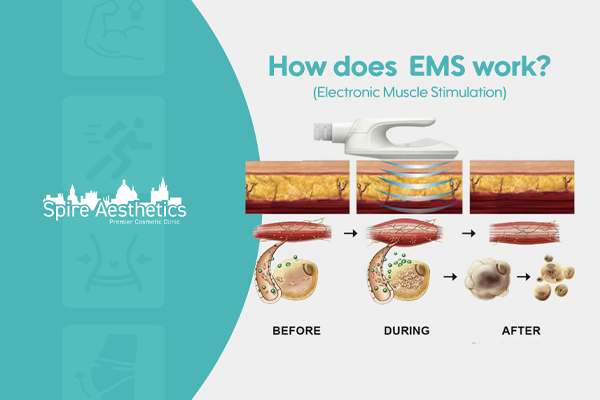 EMS treatment for post pregnancy weight loss treatment Buckinghamshire