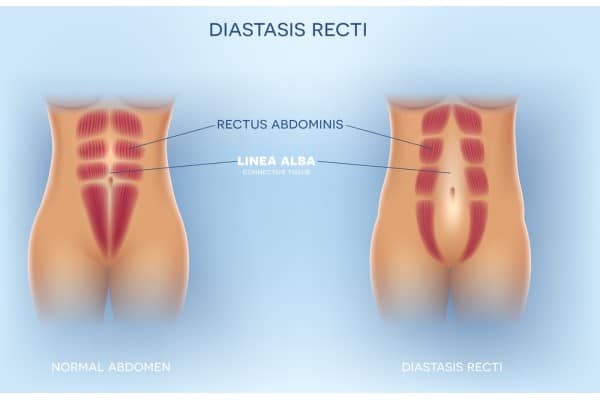What Non-Surgical Options Are Available for Diastasis Recti Buckinghamshire?