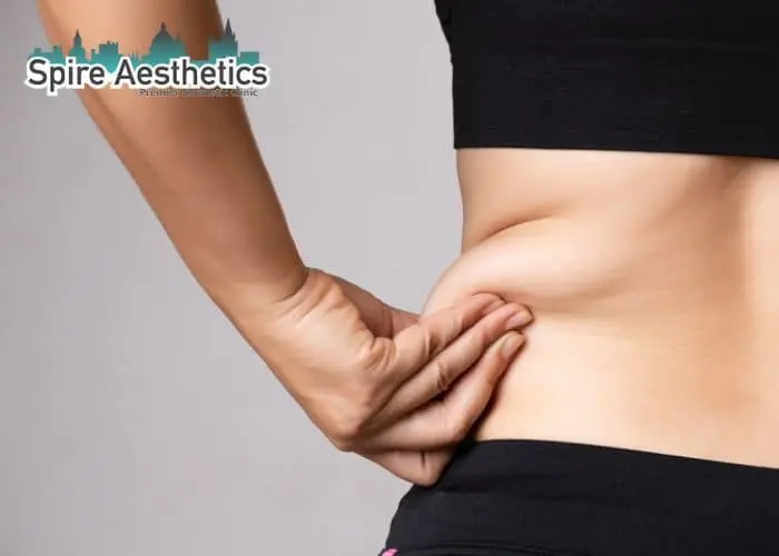 Image of woman pinching fat on their hips Buckinghamshire. Fat Freezing treatment
