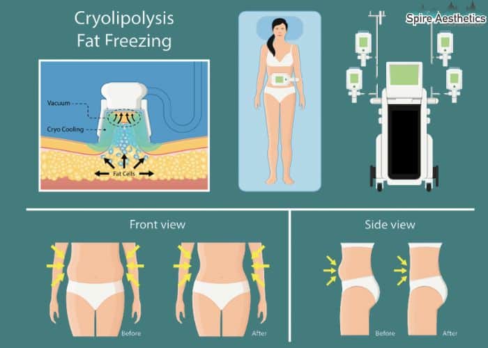 Image of diet and fat freezing combined for best results for Spire Aesthetics Buckinghamshire
