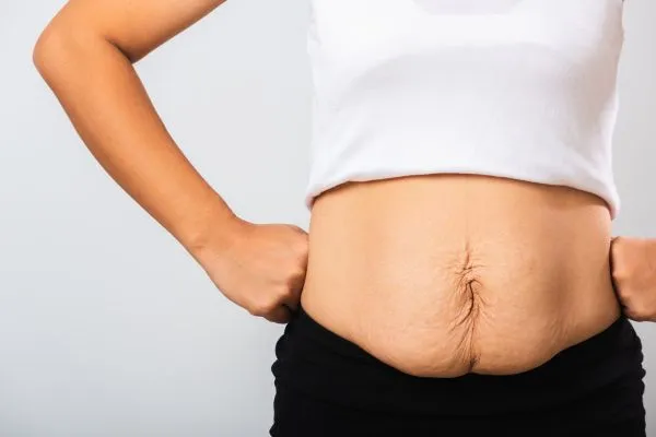 Image of a woman's stomach after weight loss with sagging skin following a gastric band Buckinghamshire