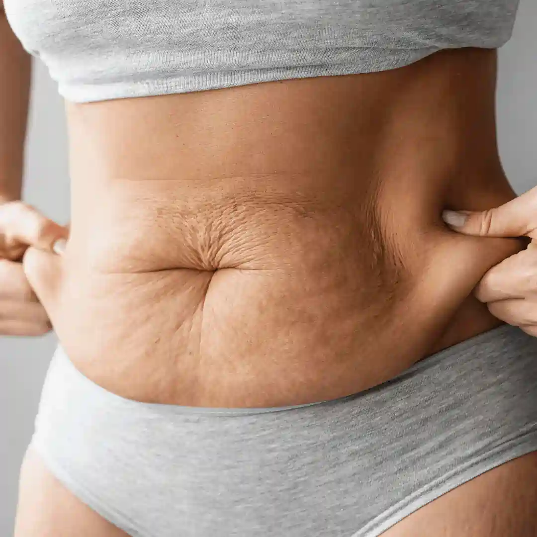 Is It Normal to Have Loose Skin After Pregnancy Buckinghamshire?