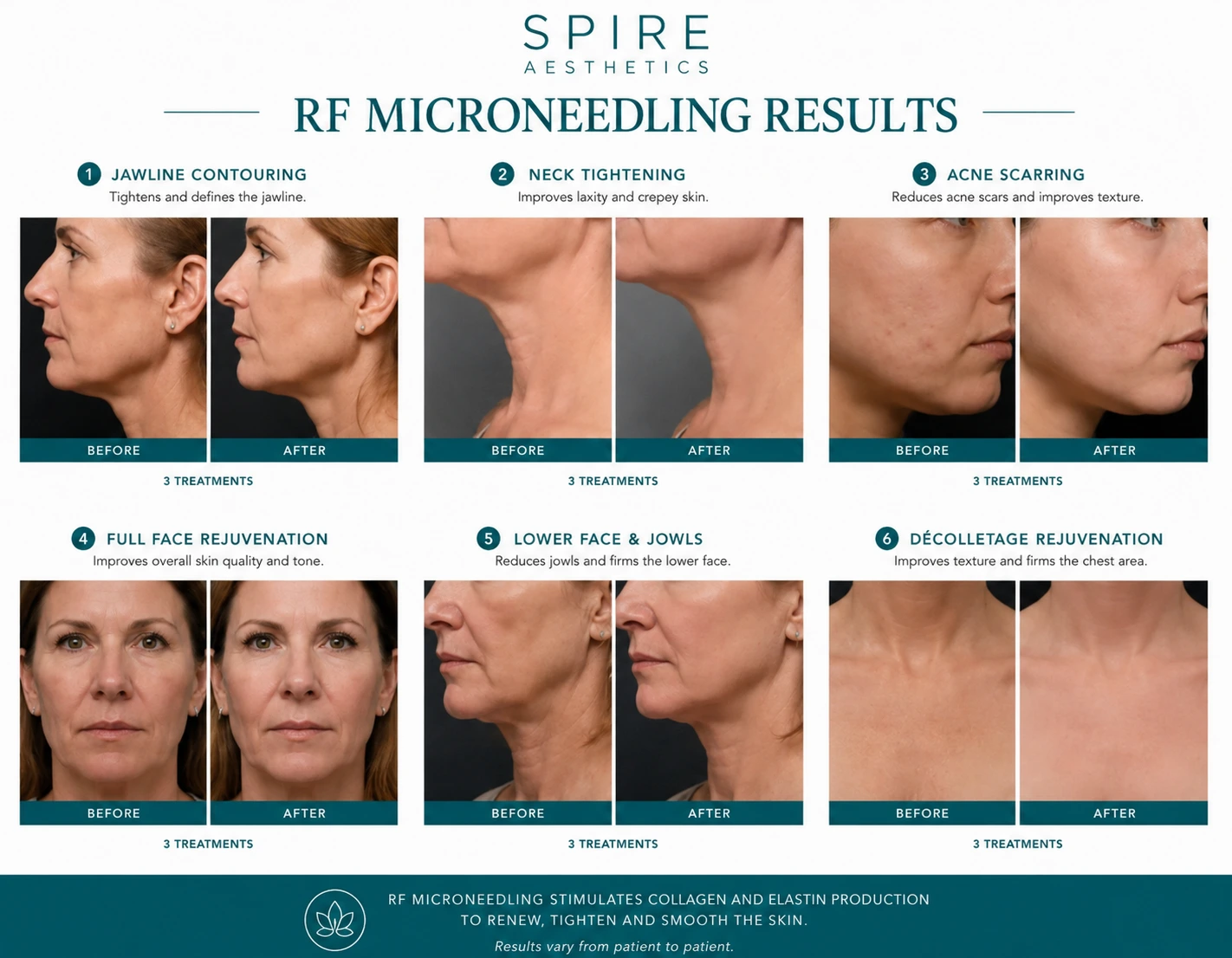 RF Microneedling Skin tightening Buckinghamshire results
