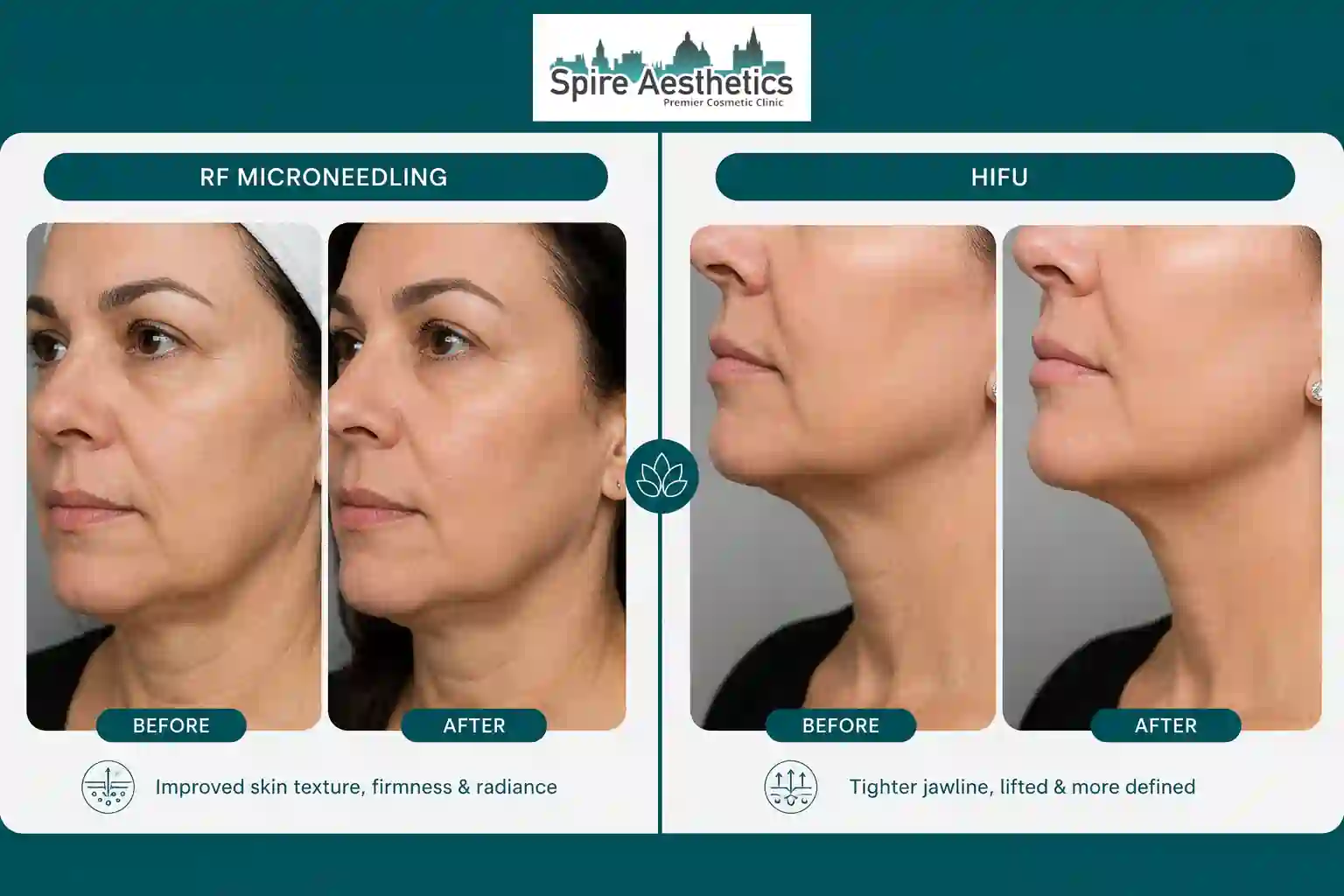 Can RF Microneedling and HIFU Be Combined Buckinghamshire?