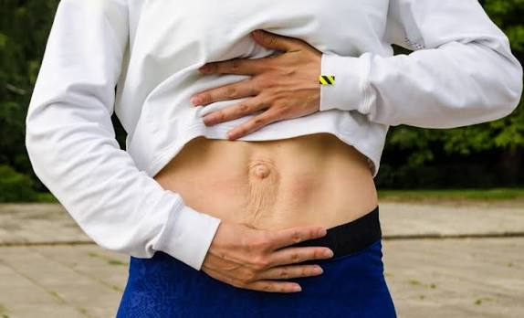 When Could Diastasis Recti Be the Missing Piece of the Puzzle Buckinghamshire?