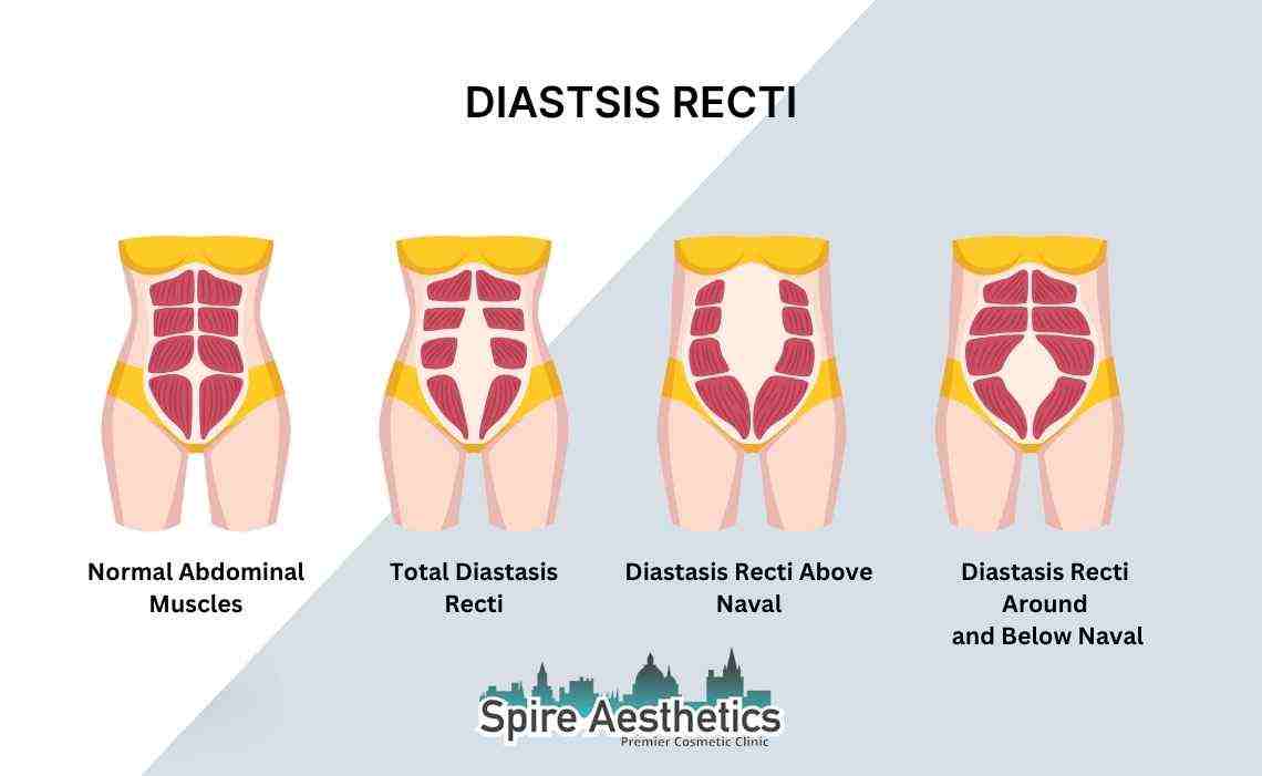 Is Non-Surgical Diastasis Recti Treatment Right for You? Common Concerns Answered Buckinghamshire